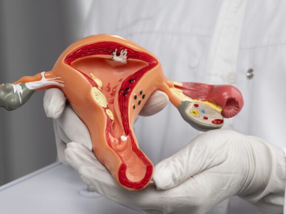 Fibroids, Endometriosis & Your Cycle: What to Watch For