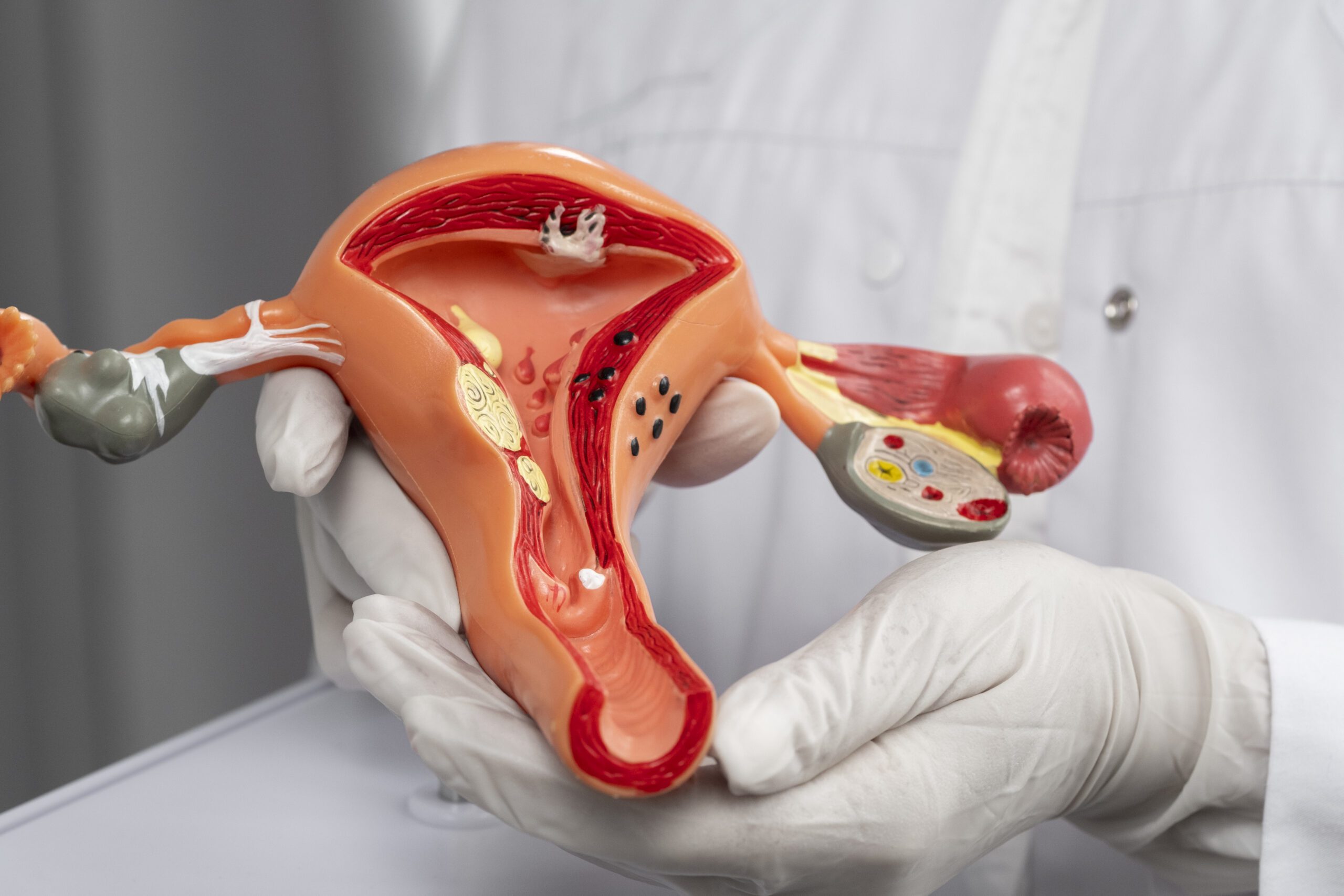 Fibroids