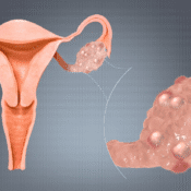 PCOS