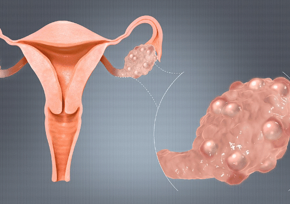 PCOS Reality Check: Symptoms, Remedies, Stories