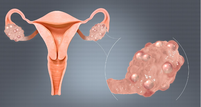 PCOS
